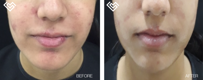 Intense Acne Treatment in India » SkinLab by Dr Jamuna Pai