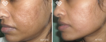 acne-scar-treatment